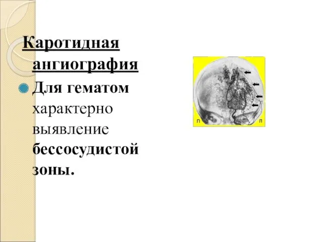 Каротидная ангиография Для гематом характерно выявление бессосудистой зоны.