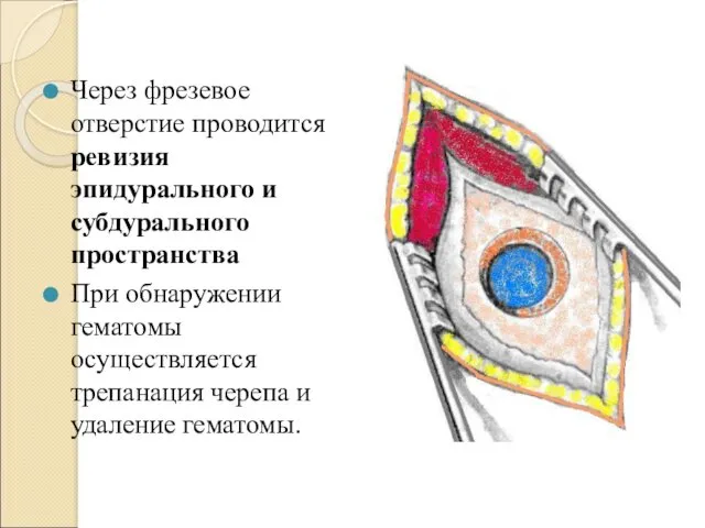 Через фрезевое отверстие проводится ревизия эпидурального и субдурального пространства При