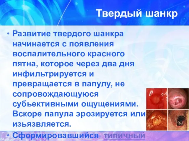 Твердый шанкр Развитие твердого шанкра начинается с появления воспалительного красного