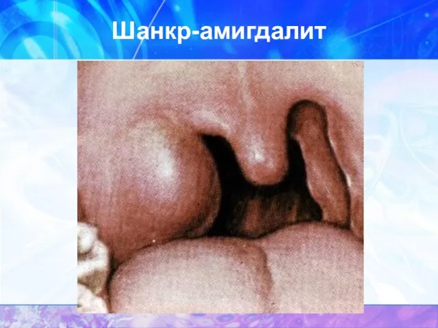 Шанкр-амигдалит