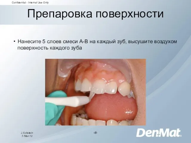 Препаровка поверхности Нанесите 5 слоев смеси A-B на каждый зуб, высушите воздухом поверхность каждого зуба