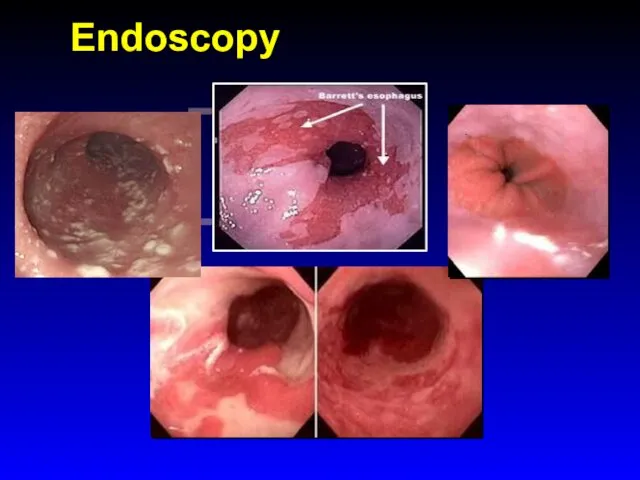 ENDOSCOPY Endoscopy