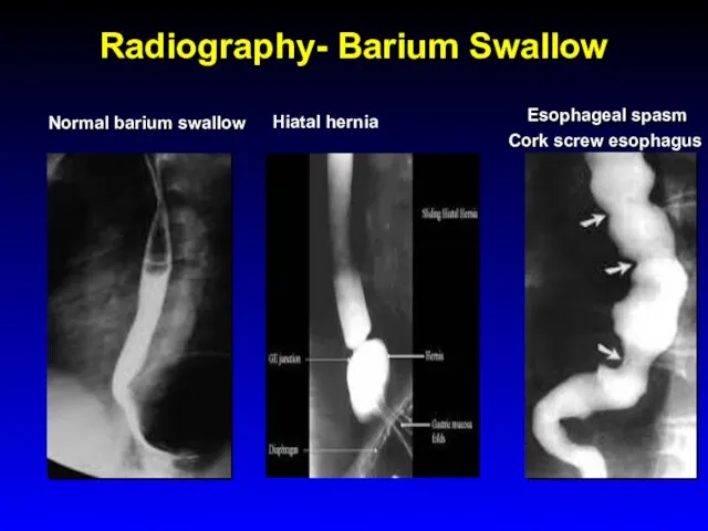Radiography- Barium Swallow Normal barium swallow Esophageal spasm Cork screw esophagus Hiatal hernia
