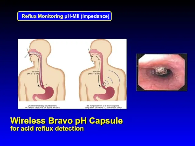 Wireless Bravo pH Capsule for acid reflux detection