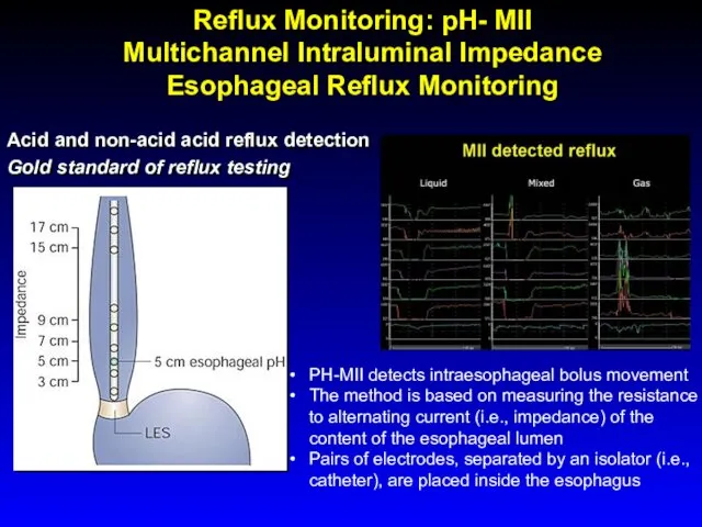 Acid and non-acid acid reflux detection Gold standard of reflux testing PH-MII detects