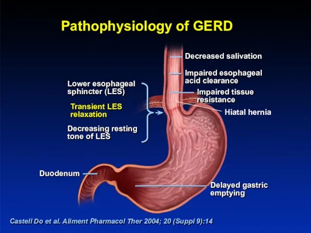 Pathophysiology of GERD Castell Do et al. Aliment Pharmacol Ther