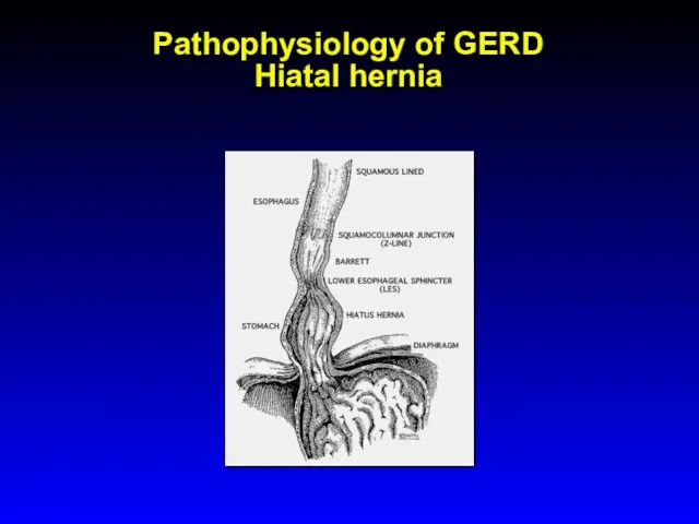 Pathophysiology of GERD Hiatal hernia
