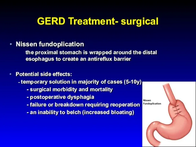GERD Treatment- surgical Nissen fundoplication the proximal stomach is wrapped around the distal