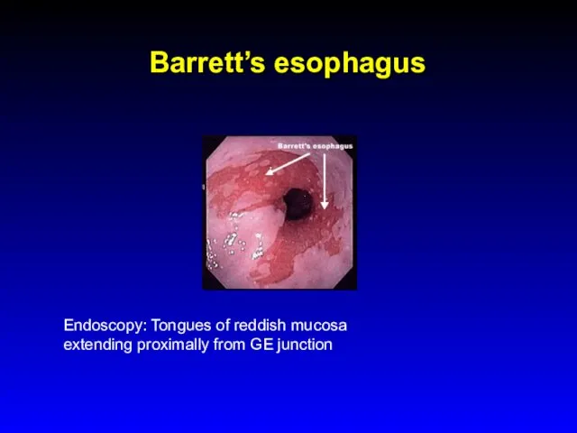 Barrett’s esophagus Endoscopy: Tongues of reddish mucosa extending proximally from GE junction