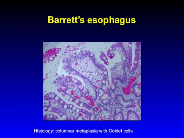 Barrett’s esophagus Histology: columnar metaplasia with Goblet cells