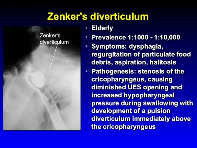 Zenker's diverticulum Elderly Prevalence 1:1000 - 1:10,000 Symptoms: dysphagia, regurgitation of particulate food