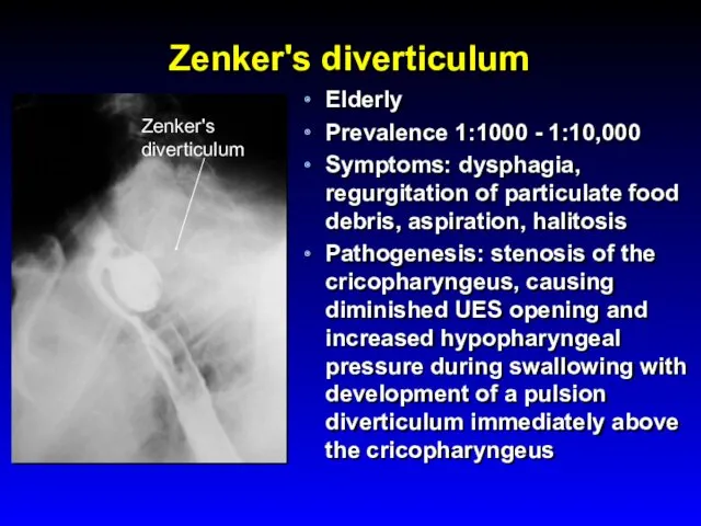 Zenker's diverticulum Elderly Prevalence 1:1000 - 1:10,000 Symptoms: dysphagia, regurgitation