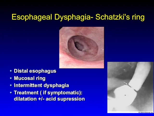 Esophageal Dysphagia- Schatzki's ring Distal esophagus Mucosal ring Intermittent dysphagia Treatment ( if
