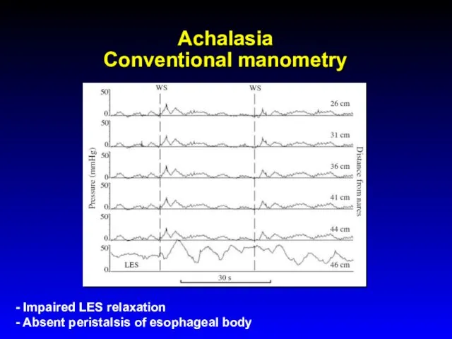 Achalasia Conventional manometry - Impaired LES relaxation - Absent peristalsis of esophageal body