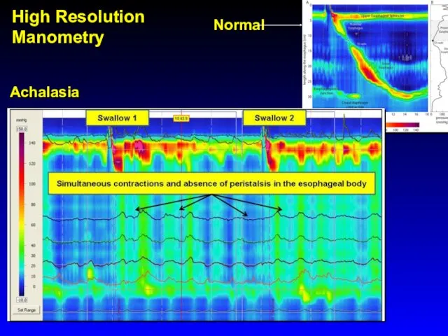 Achalasia Normal High Resolution Manometry