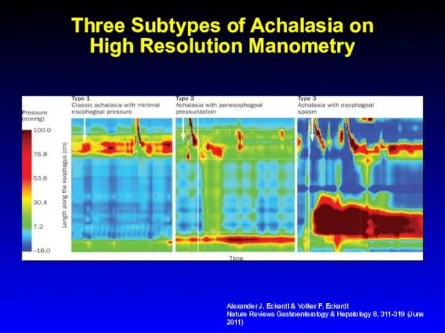 Three Subtypes of Achalasia on High Resolution Manometry Alexander J. Eckardt & Volker