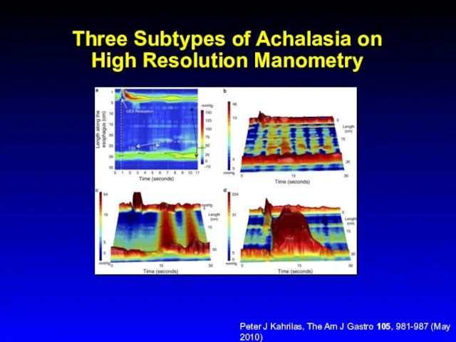 Three Subtypes of Achalasia on High Resolution Manometry Peter J Kahrilas, The Am