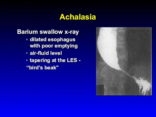 Achalasia Barium swallow x-ray dilated esophagus with poor emptying air-fluid level tapering at