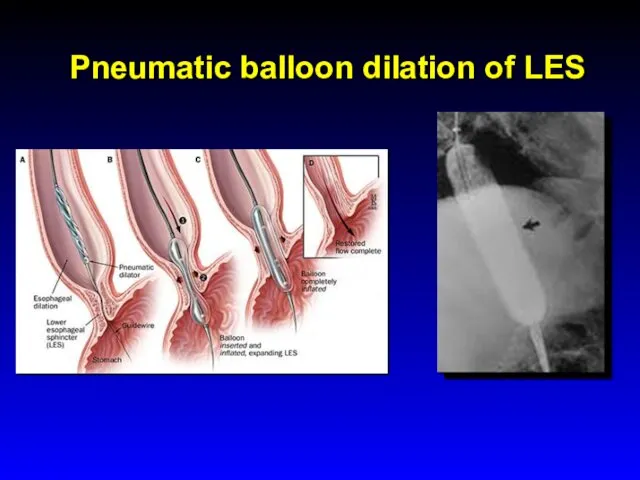 Pneumatic balloon dilation of LES