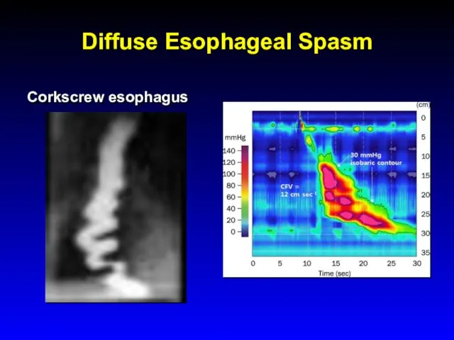 Diffuse Esophageal Spasm Corkscrew esophagus