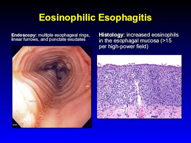 Eosinophilic Esophagitis Endoscopy: multiple esophageal rings, linear furrows, and punctate exudates Histology: increased