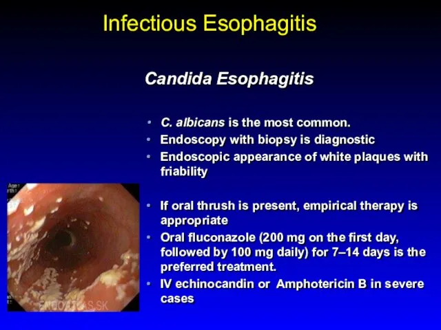 Infectious Esophagitis Candida Esophagitis C. albicans is the most common. Endoscopy with biopsy