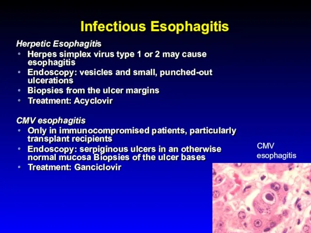Infectious Esophagitis Herpetic Esophagitis Herpes simplex virus type 1 or 2 may cause