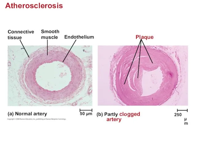 Atherosclerosis Connective tissue Smooth muscle Endothelium Plaque (a) Normal artery