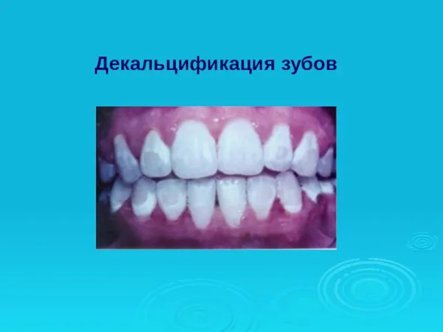 Декальцификация зубов