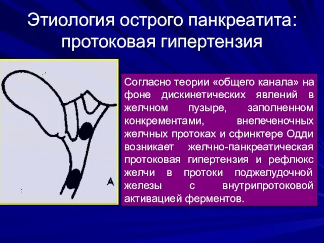 Этиология острого панкреатита: протоковая гипертензия Согласно теории «общего канала» на