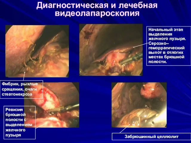 Диагностическая и лечебная видеолапароскопия Фибрин, рыхлые сращения, очаги стеатонекроза Начальный