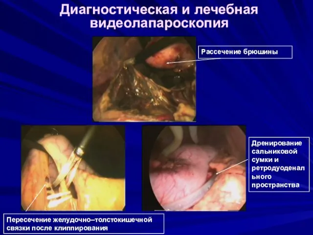 Диагностическая и лечебная видеолапароскопия Рассечение брюшины Пересечение желудочно–толстокишечной связки после