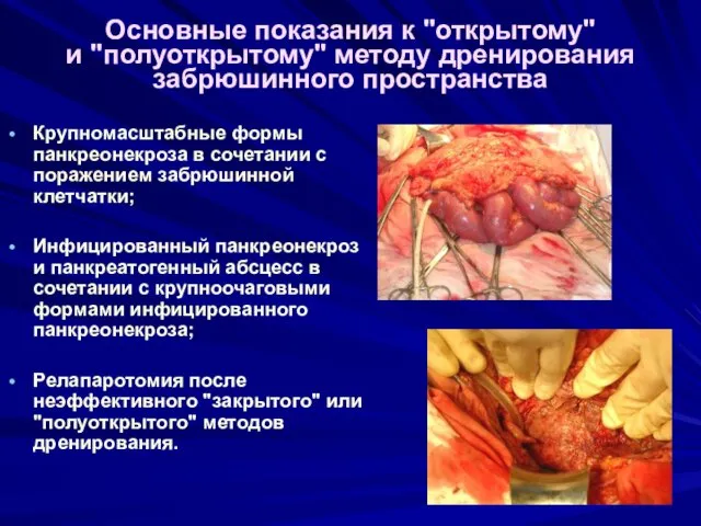 Основные показания к "открытому" и "полуоткрытому" методу дренирования забрюшинного пространства