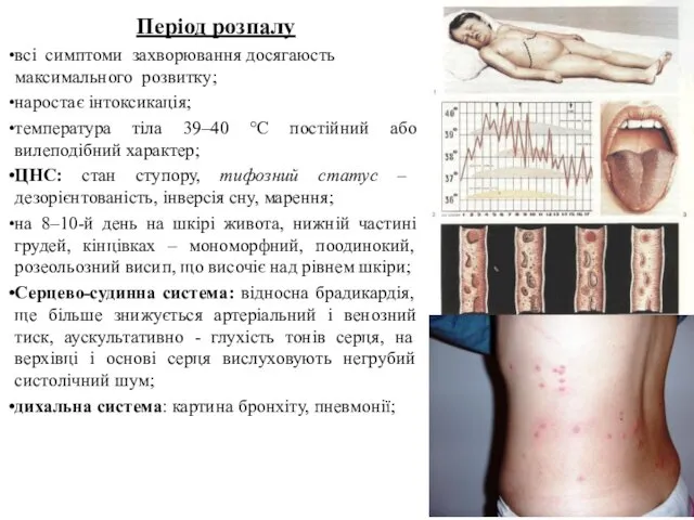 Період розпалу всі симптоми захворювання досягаюсть максимального розвитку; наростає інтоксикація;