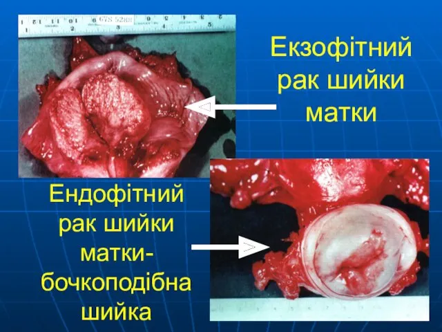 Екзофітний рак шийки матки Ендофітний рак шийки матки- бочкоподібна шийка