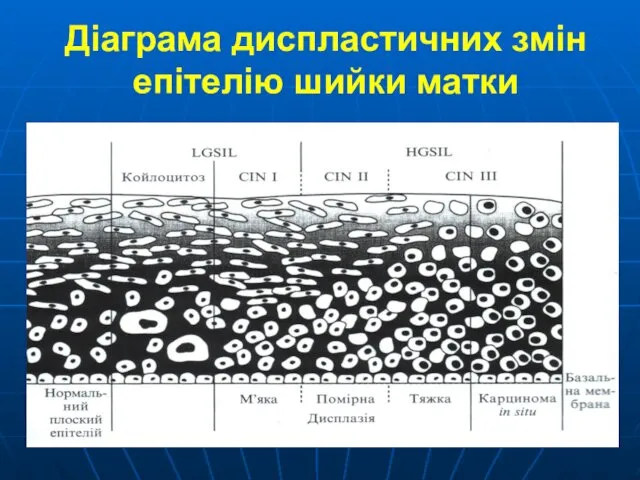 Діаграма диспластичних змін епітелію шийки матки