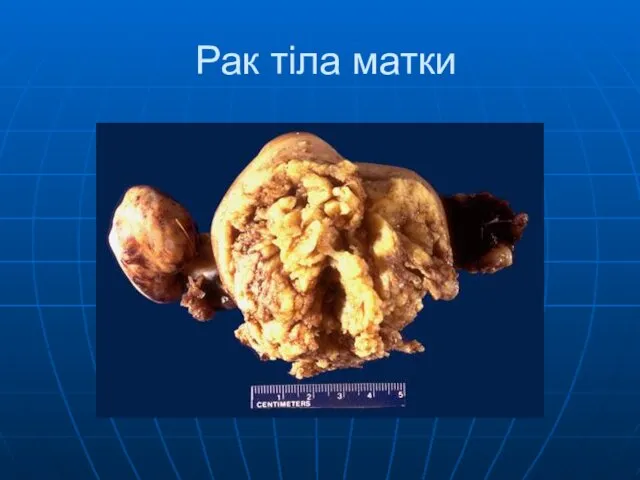 Рак тіла матки