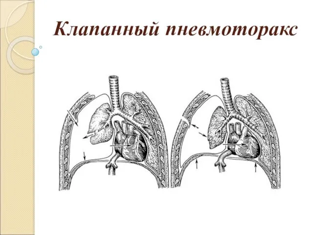 Клапанный пневмоторакс