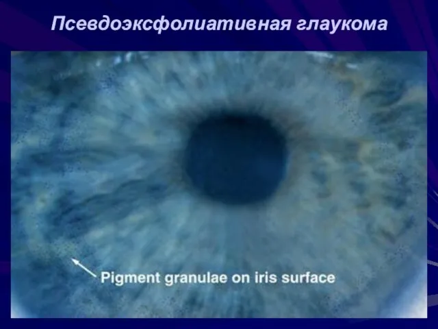 Псевдоэксфолиативная глаукома