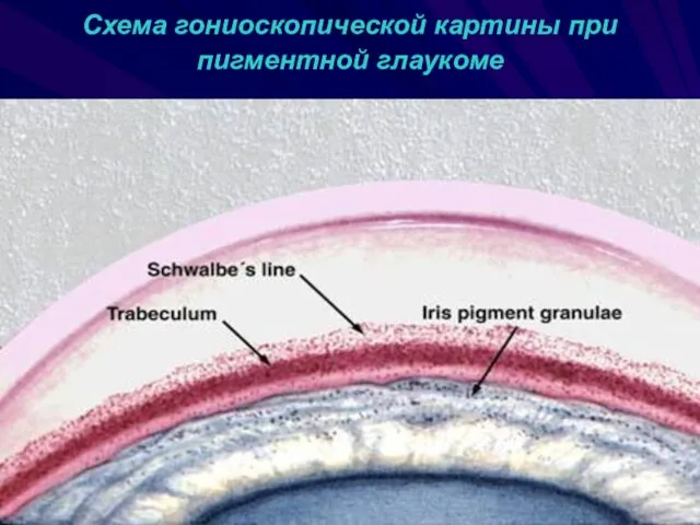 Схема гониоскопической картины при пигментной глаукоме
