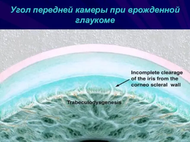 Угол передней камеры при врожденной глаукоме