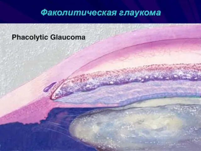 Факолитическая глаукома