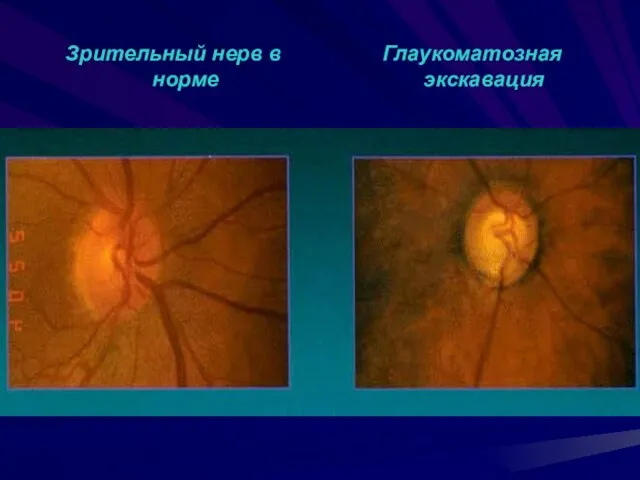 Зрительный нерв в норме Глаукоматозная экскавация