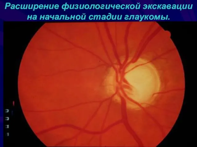 Расширение физиологической экскавации на начальной стадии глаукомы.