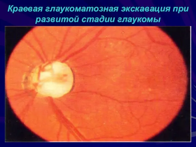 Краевая глаукоматозная экскавация при развитой стадии глаукомы