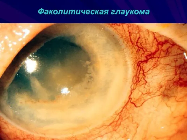 Факолитическая глаукома