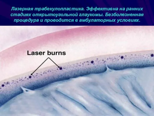 Лазерная трабекулопластика. Эффективна на ранних стадиях открытоугольной глаукомы. Безболезненная процедура и проводится в амбулаторных условиях.