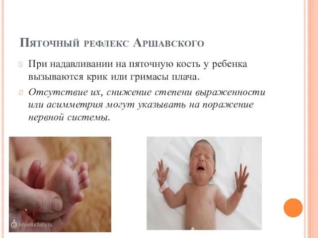 Пяточный рефлекс Аршавского При надавливании на пяточную кость у ребенка вызываются крик или