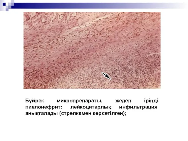 Бүйрек микропрепараты, жедел іріңді пиелонефрит: лейкоцитарлық инфильтрация анықталады (стрелкамен көрсетілген);