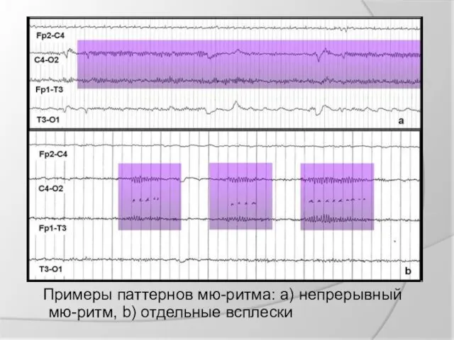 Примеры паттернов мю-ритма: а) непрерывный мю-ритм, b) отдельные всплески